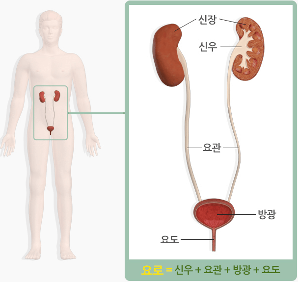 방광염