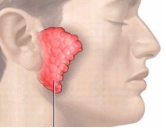 귀밑 몽우리 원인