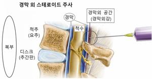 허리디스크 신경주사