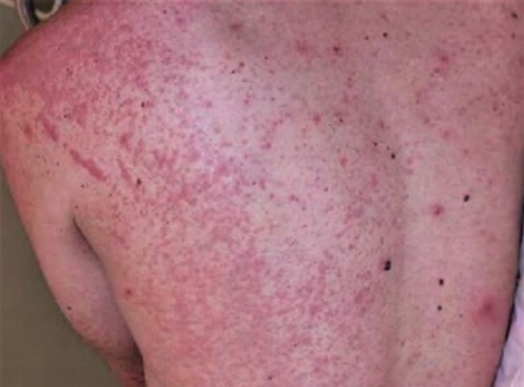 엠폭스 뜻 어떤 증상 및 원인 엠폭스 격리 및 예방접종