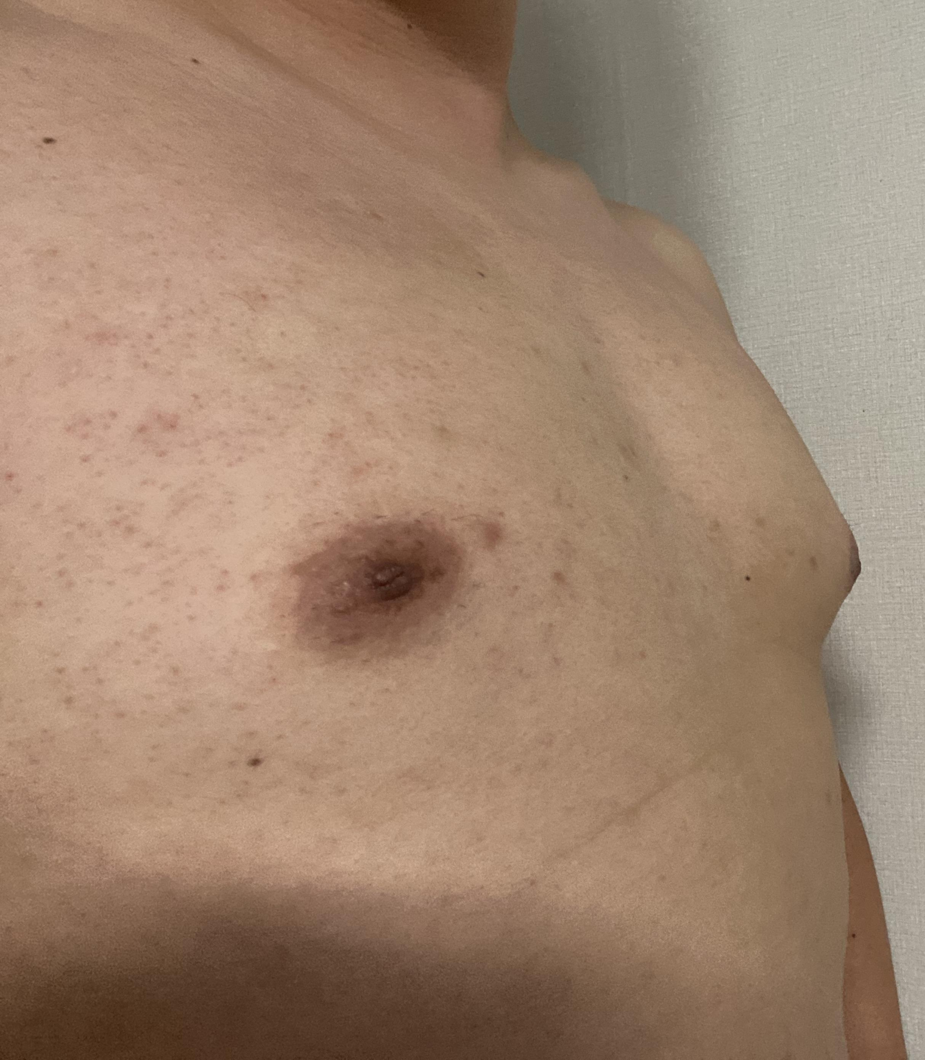 여유증 수술 전 사진 옆 모습