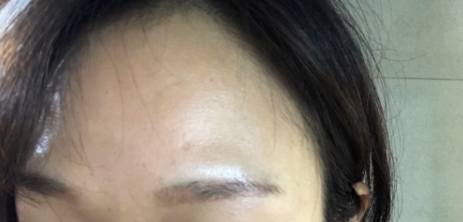 이마 미간 보톡스 후기4
