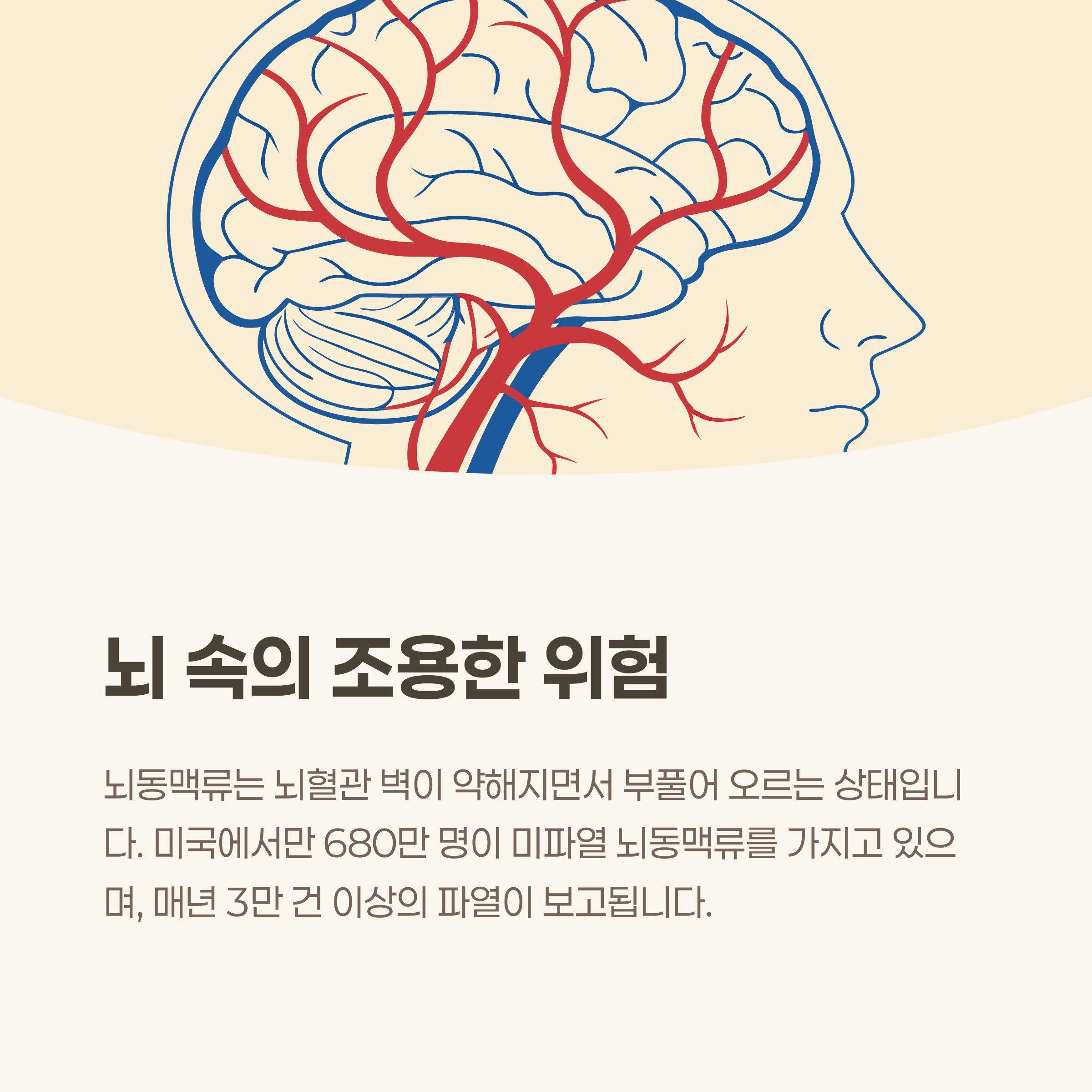 뇌동맥류란 무엇인가요? 뇌 속의 조용한 위험