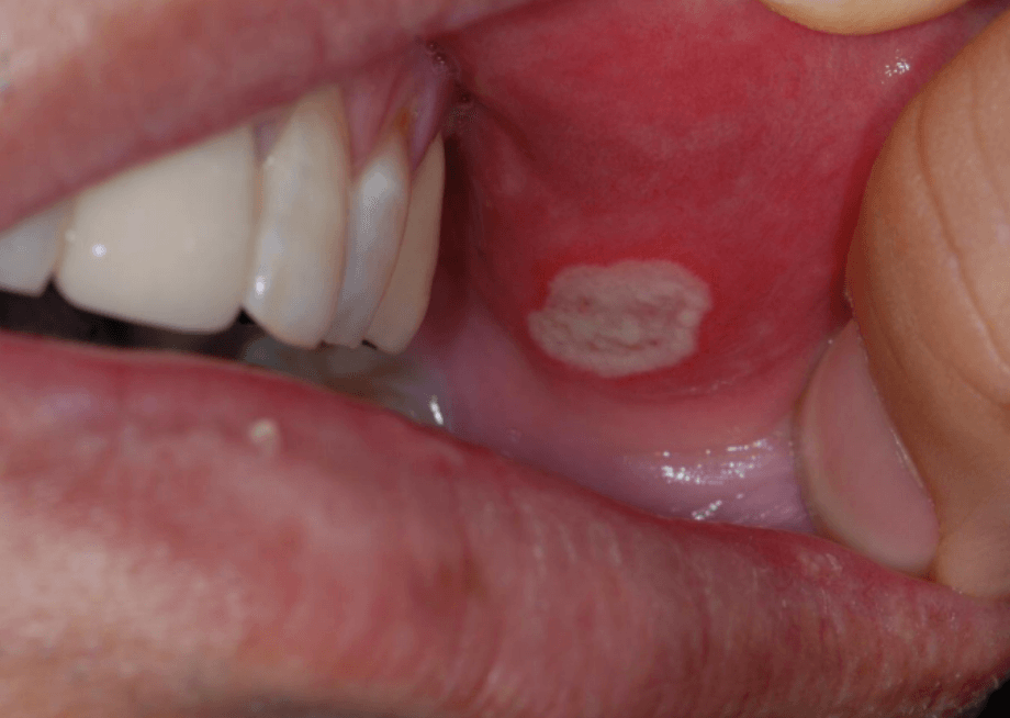 구내염 빨리 낫는법