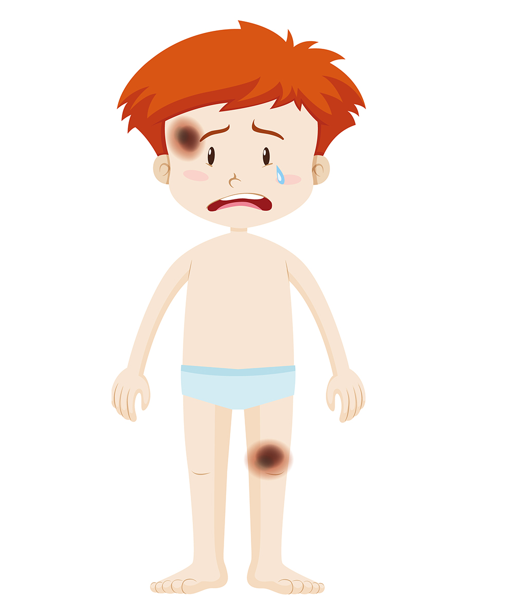 한 남자아이의 얼굴과 무릎에 멍이 들어있는 그림