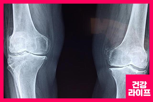 무릎 관절염