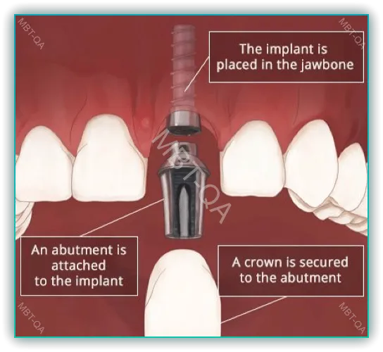 앞니 임플란트1