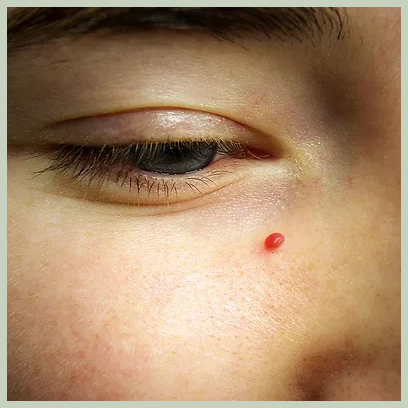 체리혈관종 발생원인