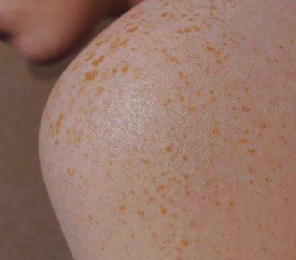 엽산 효능 : 피부