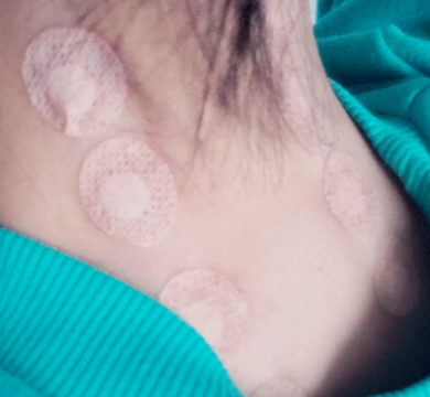 정형외과주사맞은자국