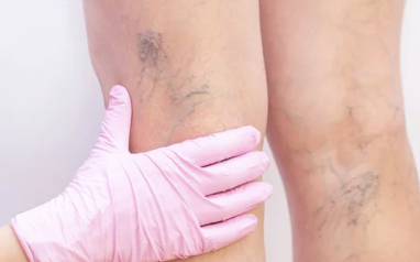 하지정맥류의 주요 증상