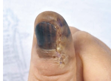 하조피에 흑색종이 침윤 출처 서울대병원