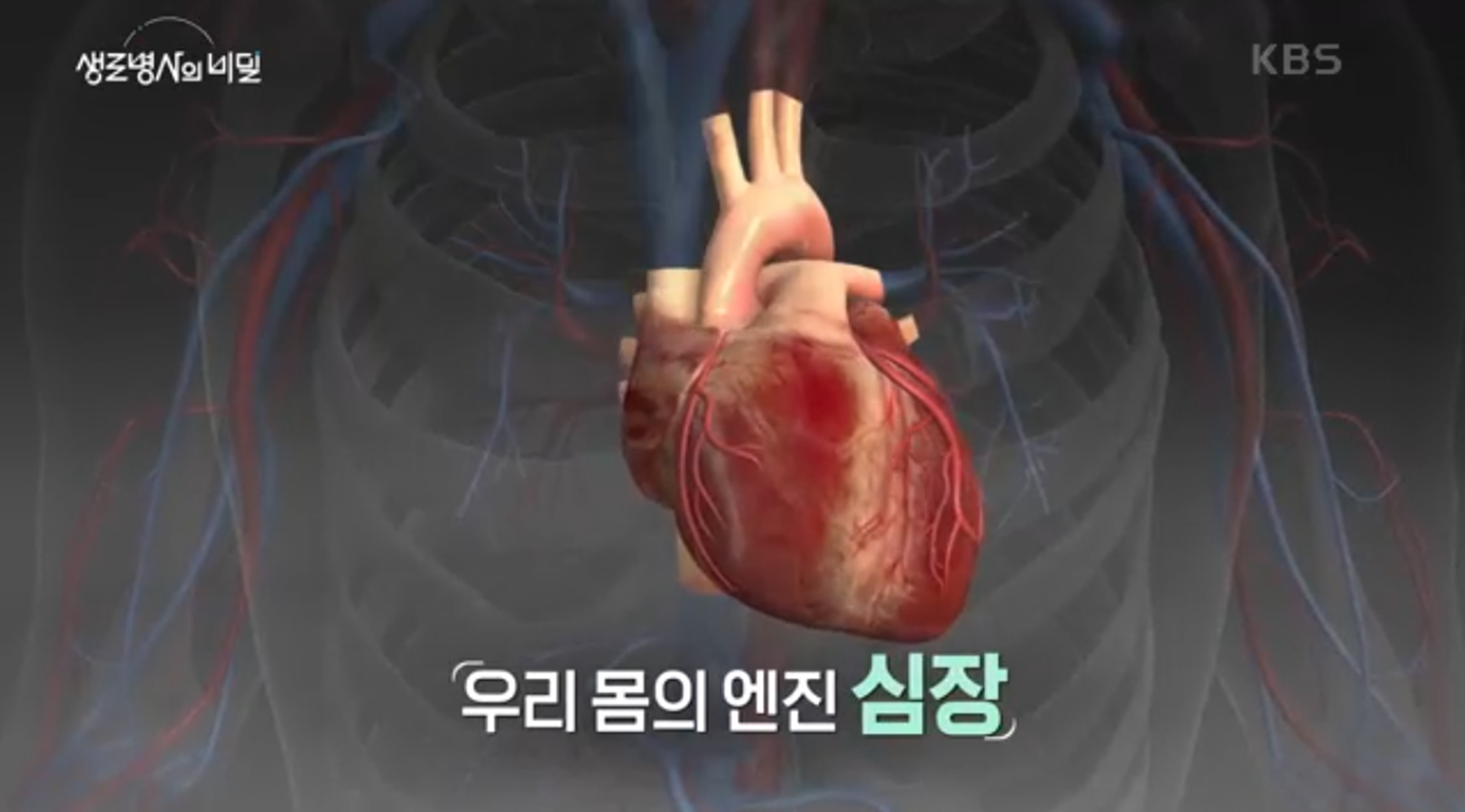 심근경색