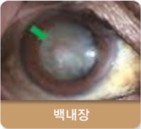 백내장 수술