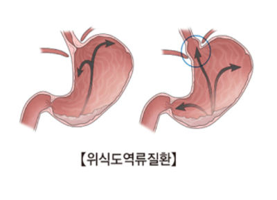 역류성 식도염 증상