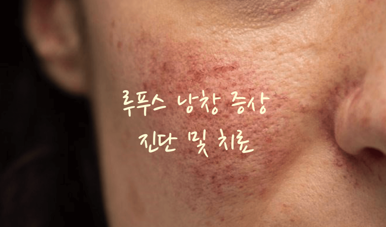 루푸스 낭창