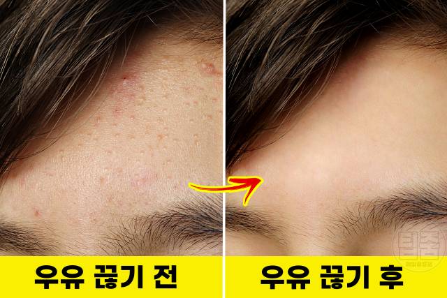 우유 끊으면 우유끊기 여드름