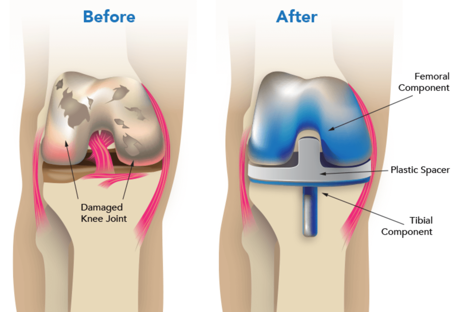 무릎인공관절수술비용