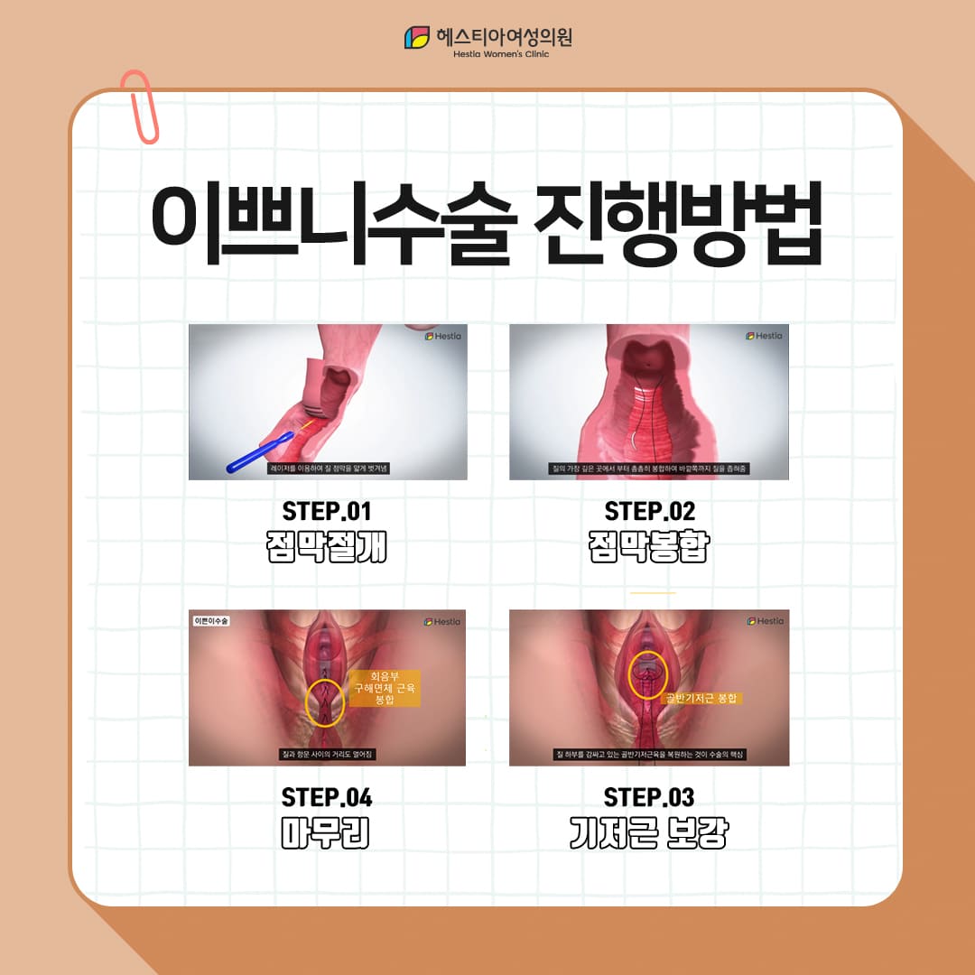 질성형 이렇게 진행됩니다.