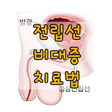 전립선비대증치료, 원인, 증상, 치료법 총정리!