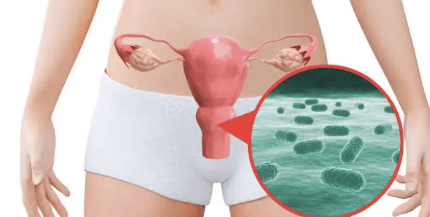 질 유산균이 여성건강에 미치는 효과와 질 유산균 추천