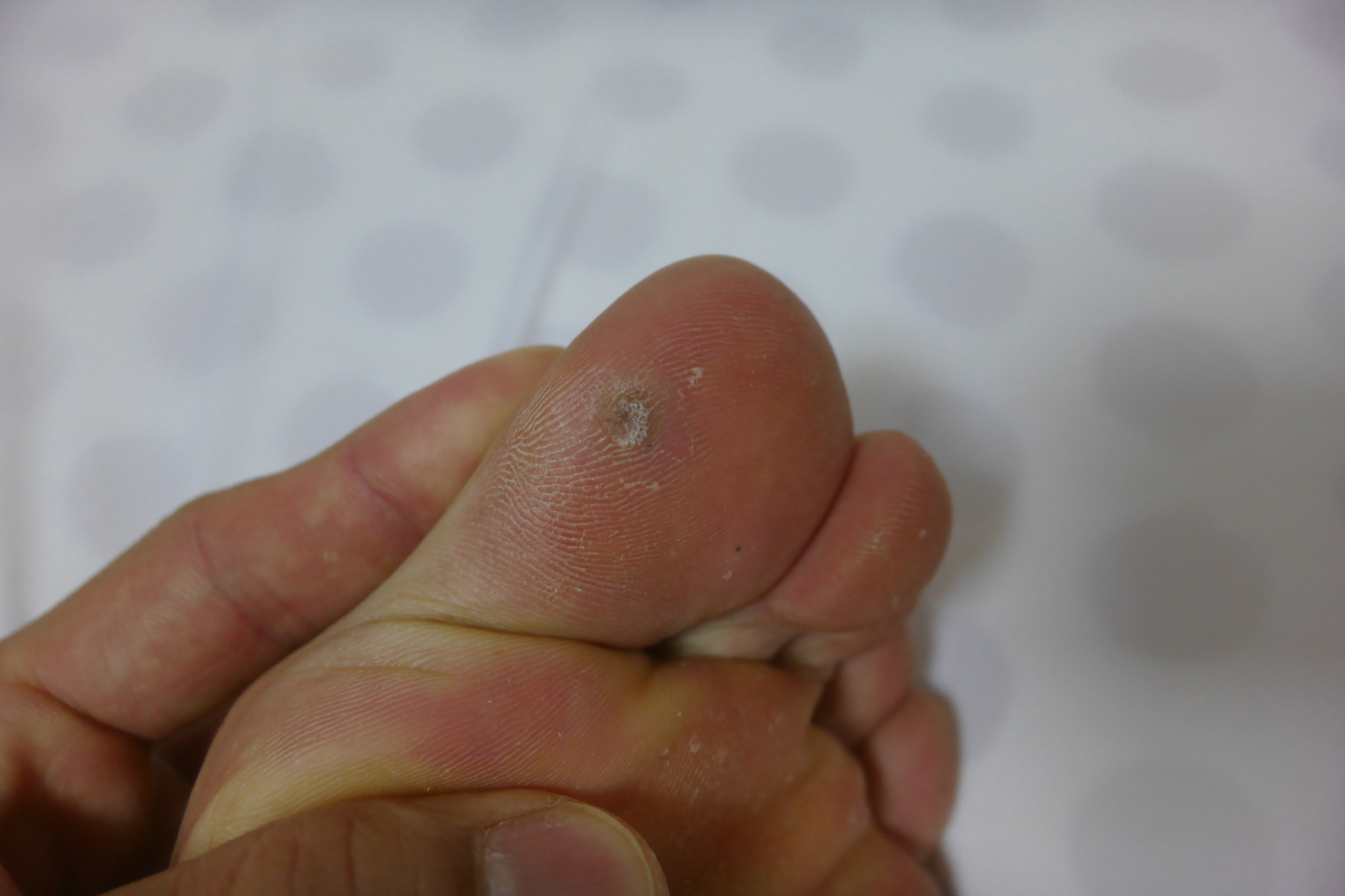 티눈 생기는 이유 발가락 발바닥 티눈 제거 방법