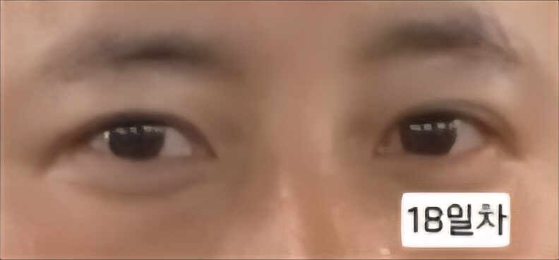 유행성각결막염 치료과정 증상 시력저하 회복과정 발병2주 3주 기록