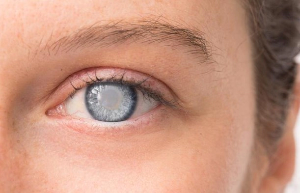 백내장 증상 6가지