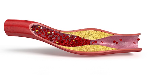 콜레스테롤 정상수치