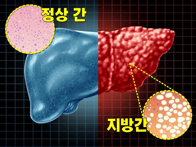 지방간 단백질 부족 증상, 단백질 부족을 알리는 우리 몸의 7가지 신호, 건강 팁줌 매일꿀정보