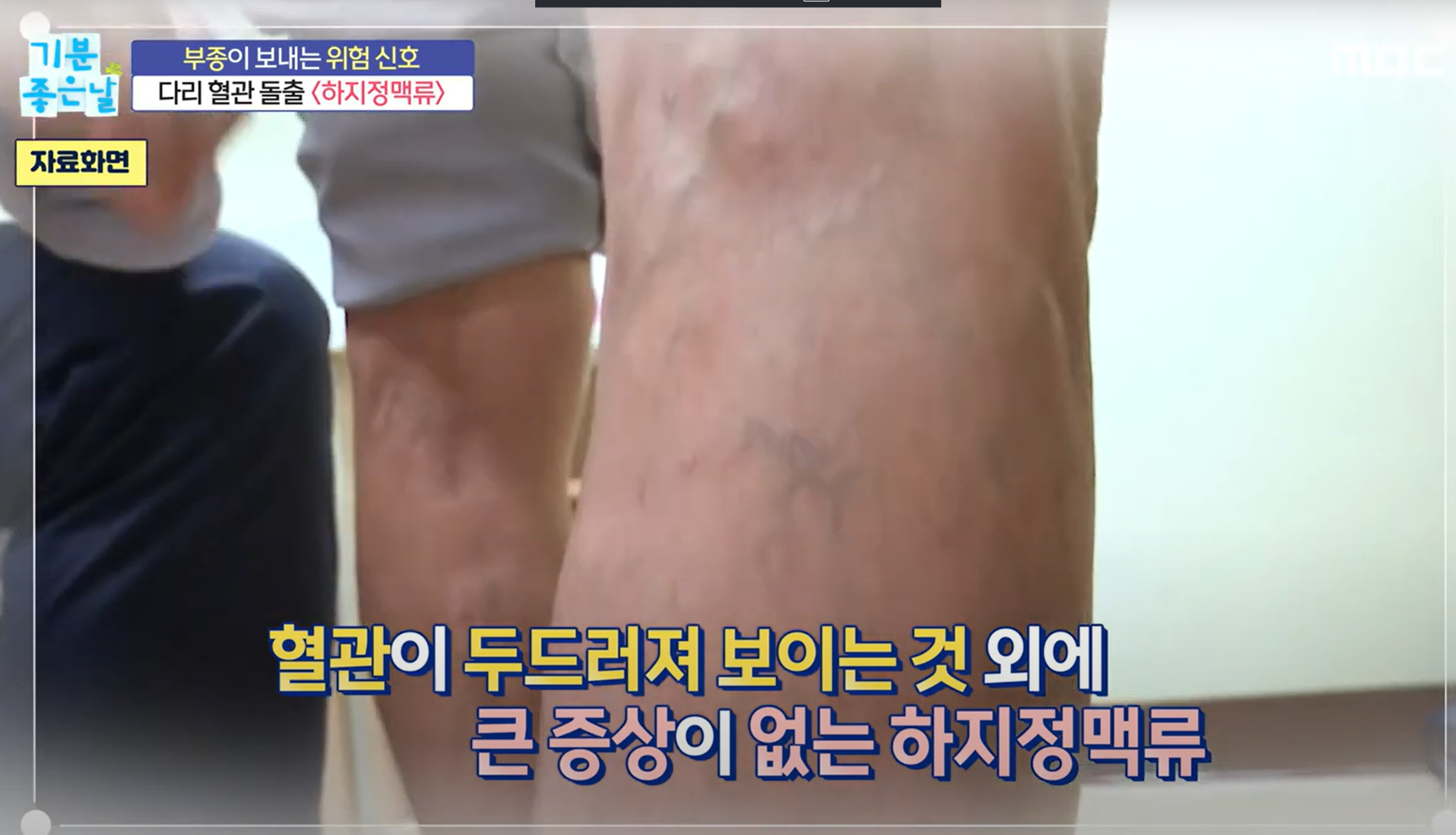 하지 정맥류