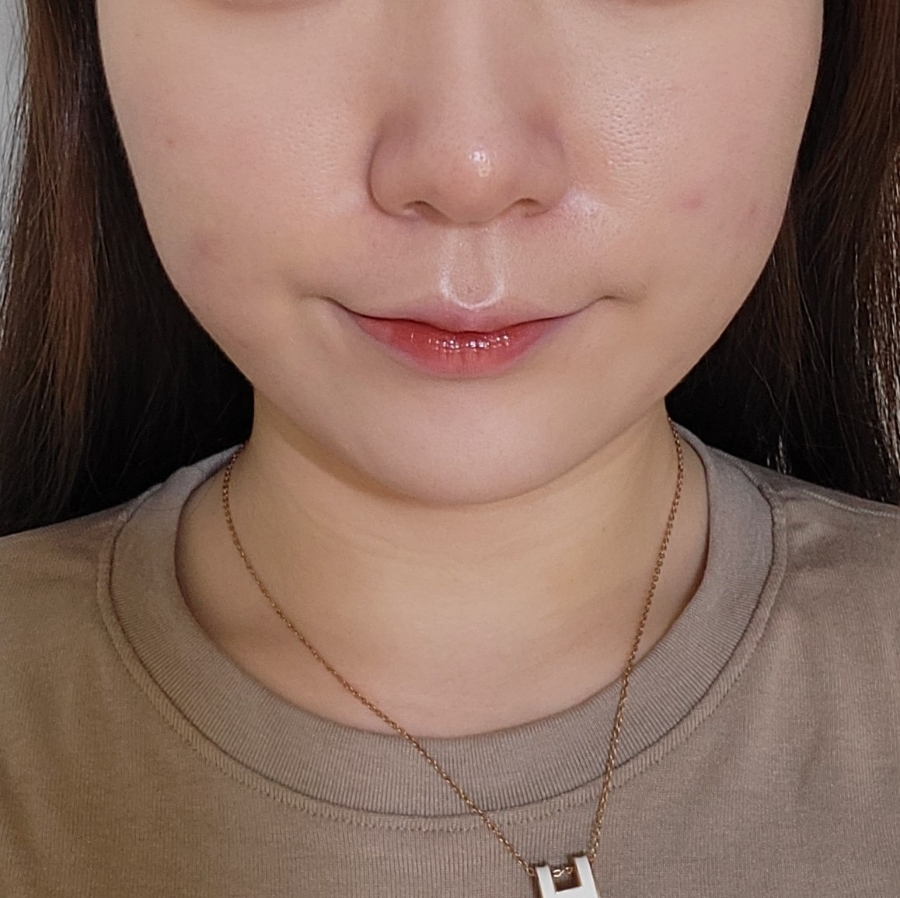 bbl 레이저 후기