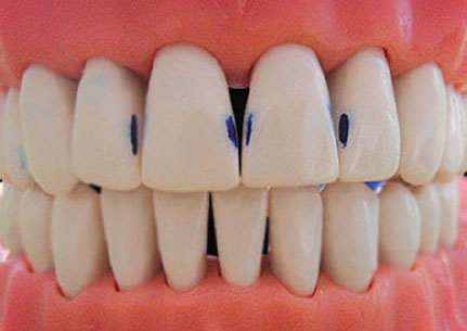 치아미백 사전 검사