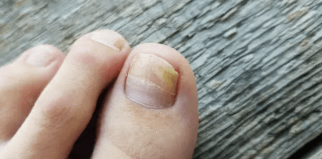 여름철 무좀 원인, 무좀 증상, 무좀 약 치료 방법 총정리