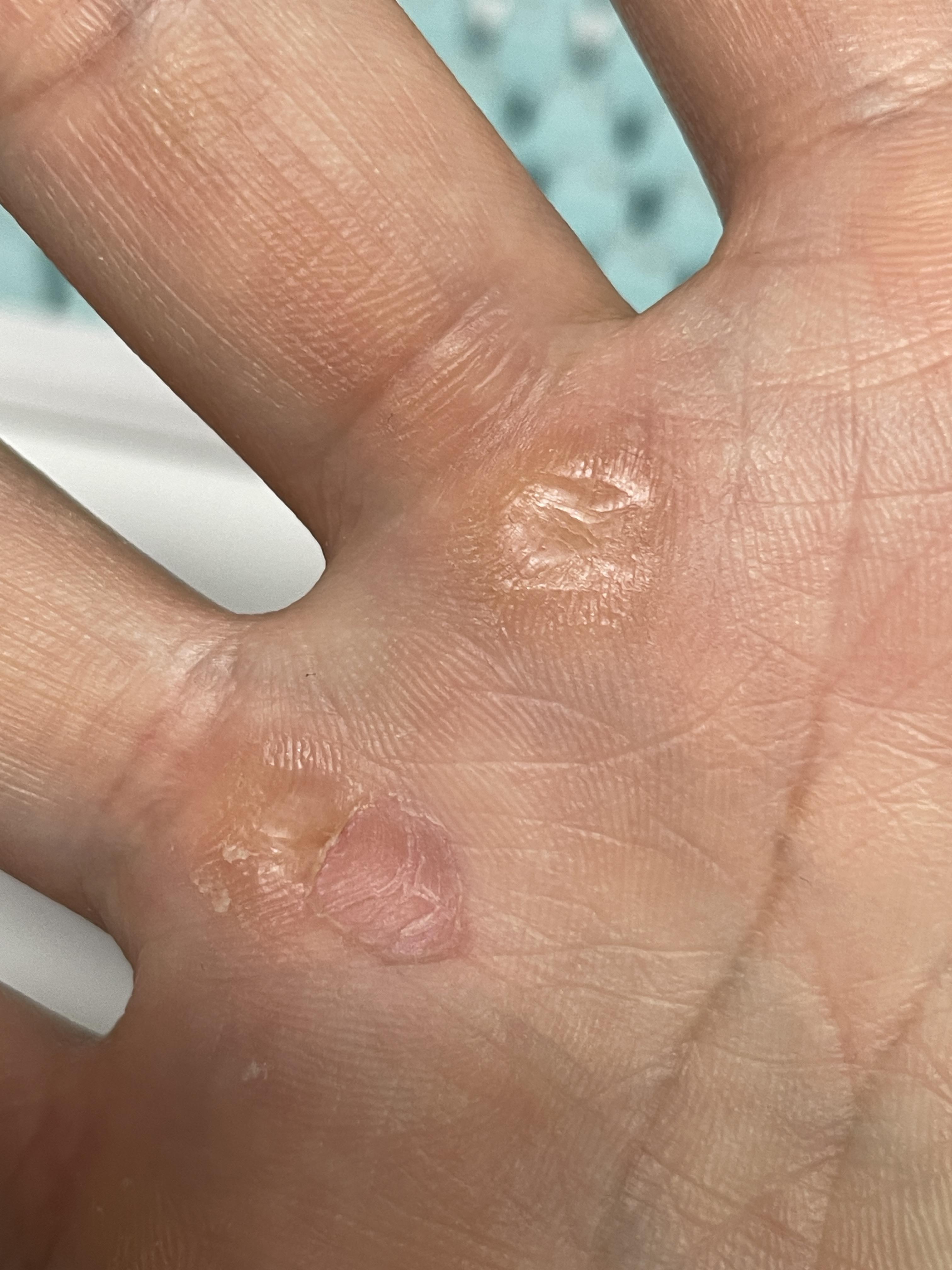 손바닥 굳은살 제거