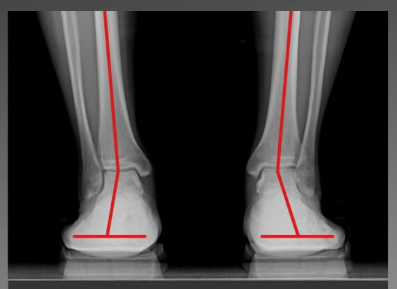 골-스튜디오-슬리퍼-공식-홈페이지에-있는-발-엑스레이-사진