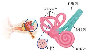 이석증 증상
