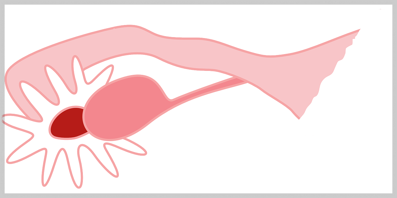 다낭성 난소증후군1