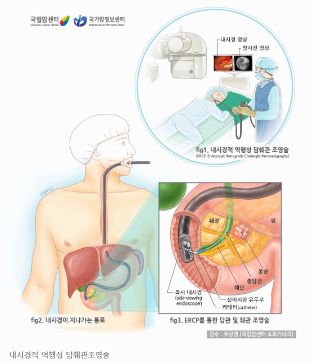 췌장암 초기 증상 총정리 조기 발견과 예방을 위한 완벽 가이드