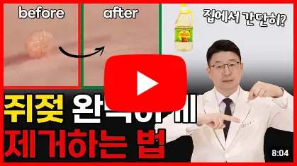 쥐젖 완벽히 제거하는 방법