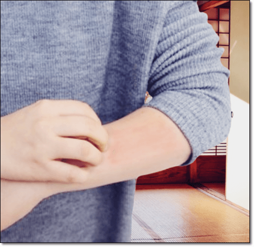 옻 알레르기 증상