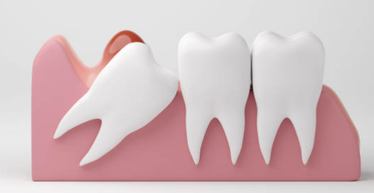 사랑니 발치후 식사 주의사항 가이드