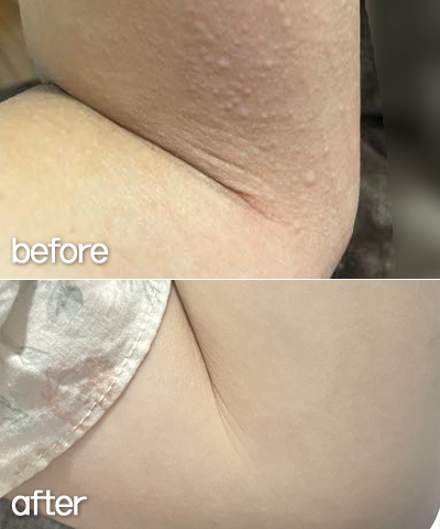 팔 좁쌀 두드러기