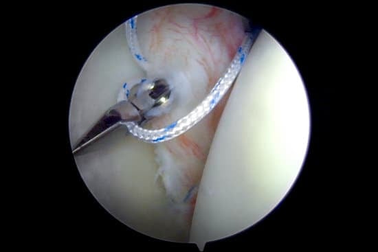반카르트 병변(Bankart Lesion) 및 수술
