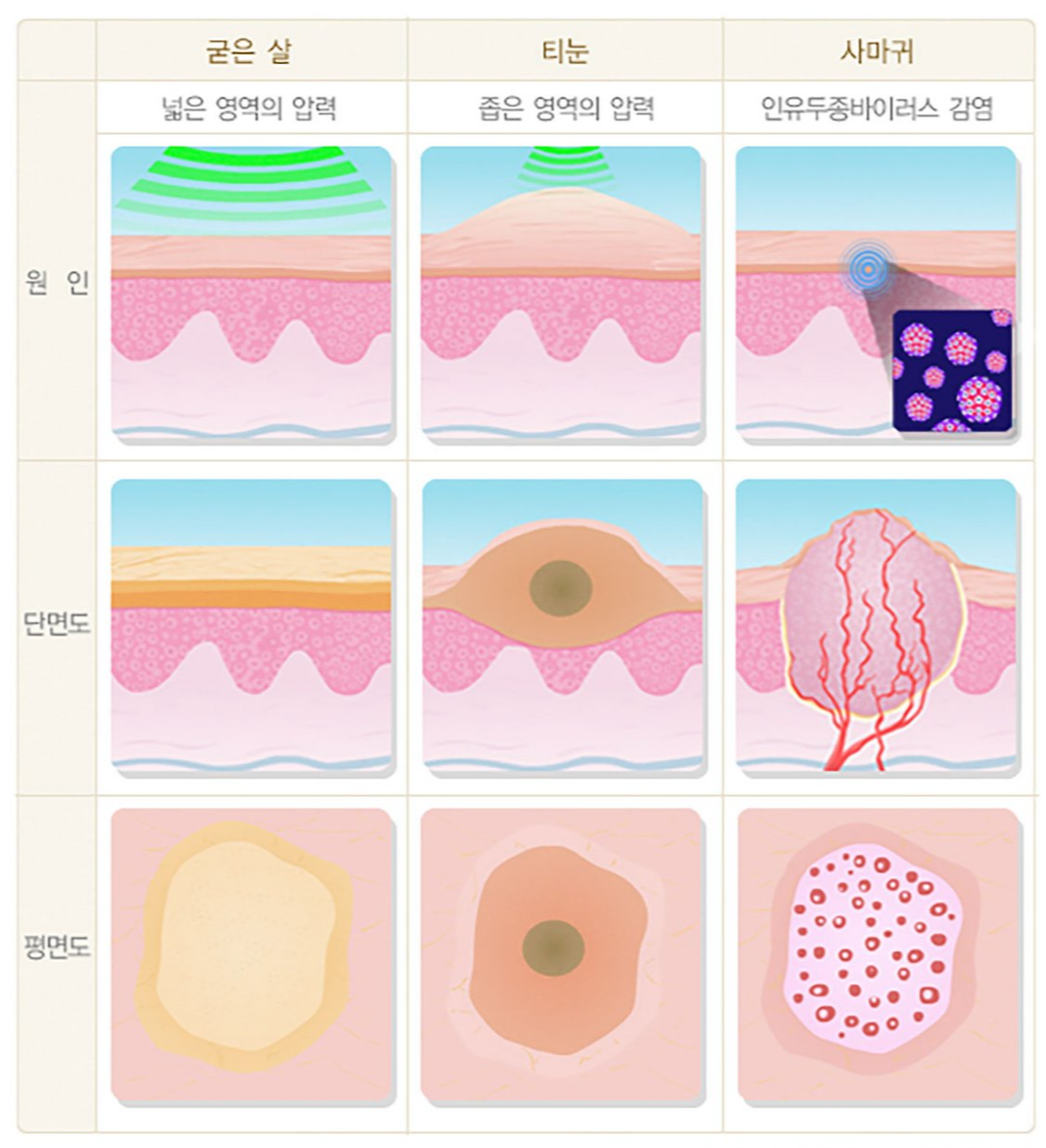alt="굳은살, 티눈, 사마귀 비교 출처 질병관리청"