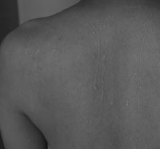 두드러기 치료방법 진단 기준 합병증