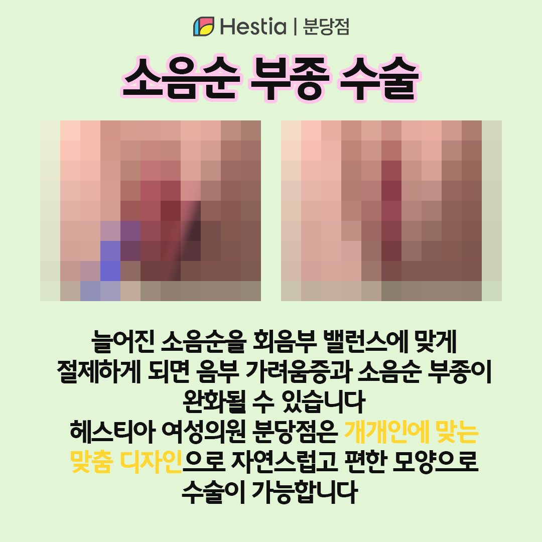 음부 가려움증 소음순 부종 소음순 부종 수술 방법