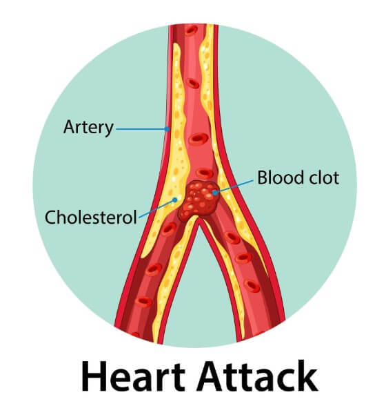 혈액 속 콜레스테롤 기준