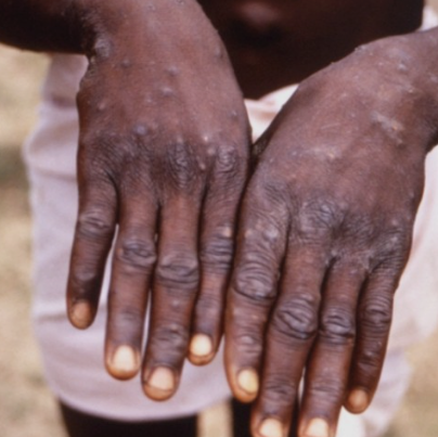 엠폭스-초기증상