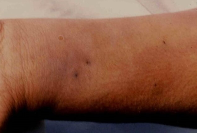 뱀에-물렸을때-주의사항